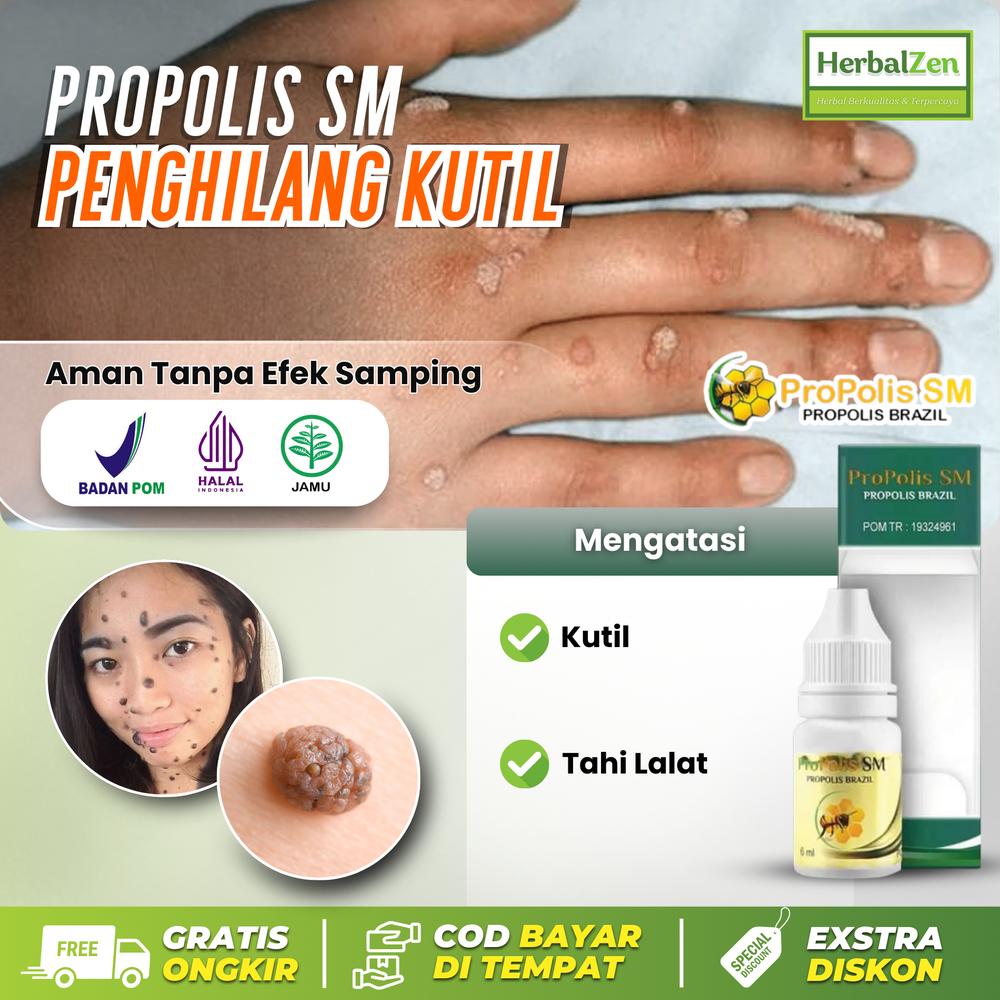 Cairan Penghilang Kutil Dan Tahi Lalat Dengan Propolis SM