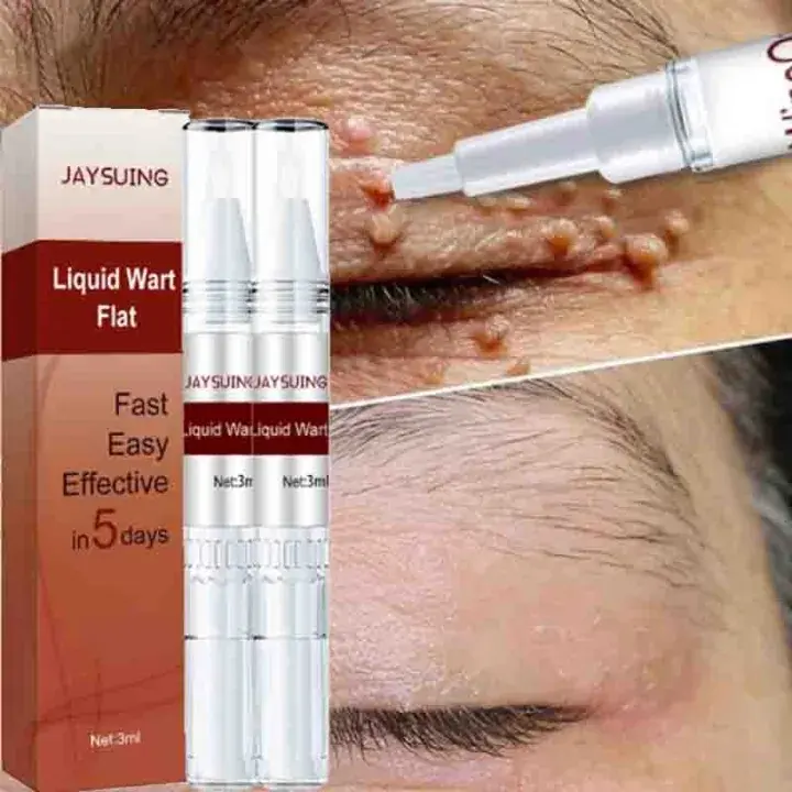 Jaysuing Liquid Wart Flat 3ml - Cairan Menghilangkan Kutil dan Tahi Lalat Pada Tubuh Aman dan Cepat