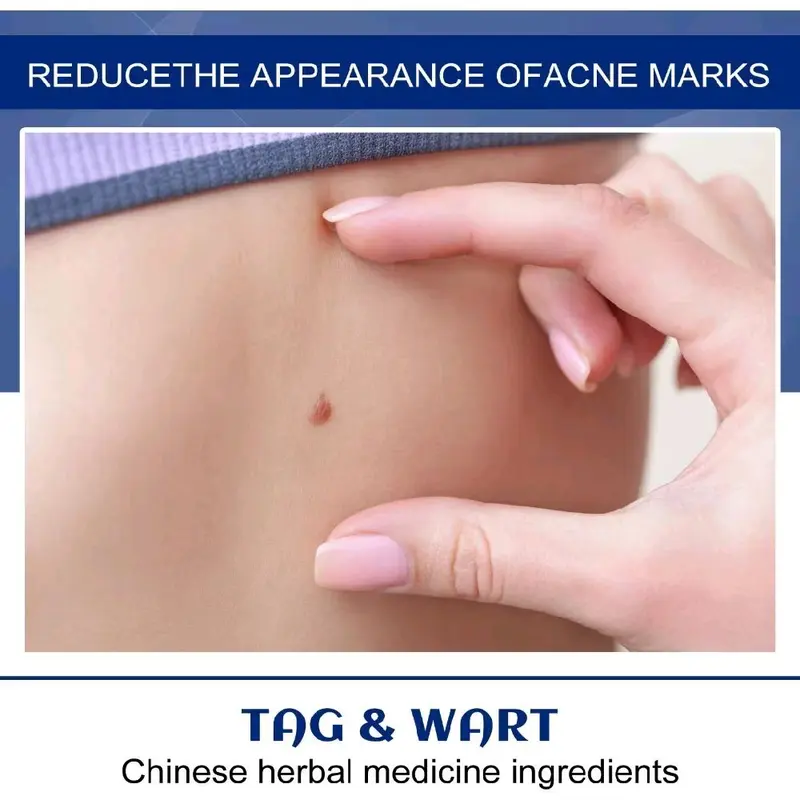 Cream Penghilang Tai Lalat Kutil Ampuh Wart Remover Skin Tag Oitment 4