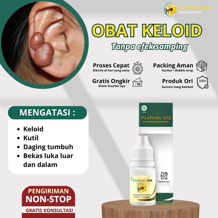 Gambar Keloid Daging Tumbuh Daging Jadi Penghilang Keloid Luka Tindik Di Telinga Bekas Operasi Penghilang daging tumbuh, keloid Menahun, Propolis sm dari Herbalthy Store Kota Administrasi Jakarta Barat Tokopedia