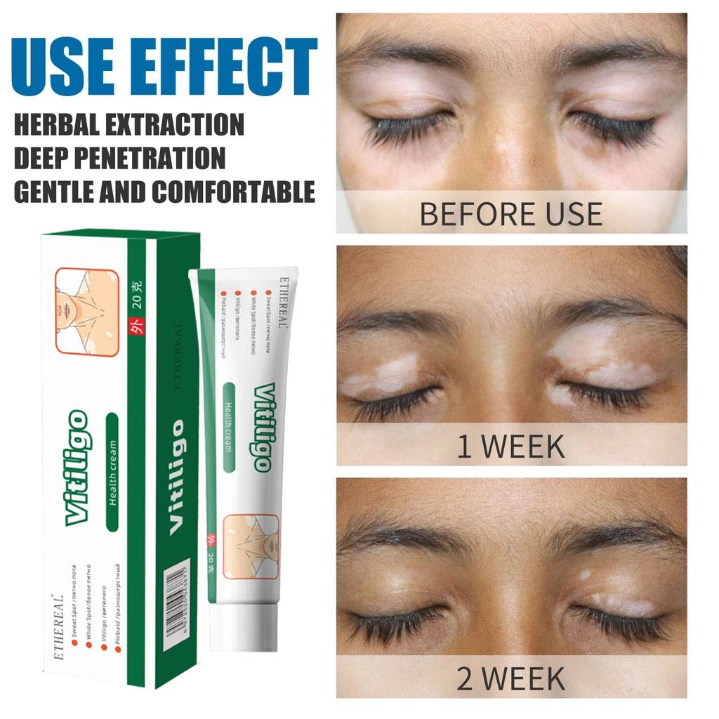 salep khusus bercak putih vitiligo salep vitiligo, bercak-bercak putih vitiligo cream bercakputih penyakit kulit putih/panu putih/kudis putih/lepra putih salep khusus bercak putih vitiligo salep vitiligo, bercak-bercak putih vitiligo cream bercakputih penyakit kulit putih/panu putih/kudis putih/lepra putih