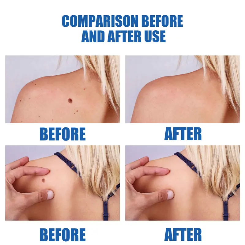 Wart Removal Pen Krim Penghilang Lalat, Krim Penghilang Kutil, Mudah Dibawa Untuk Semua Kulit, Krim Penghilang Kutil 5