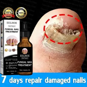 EELHOE Nail serum obat penghilang jamur kuku bernanah dan cantengan ampuh original 100%