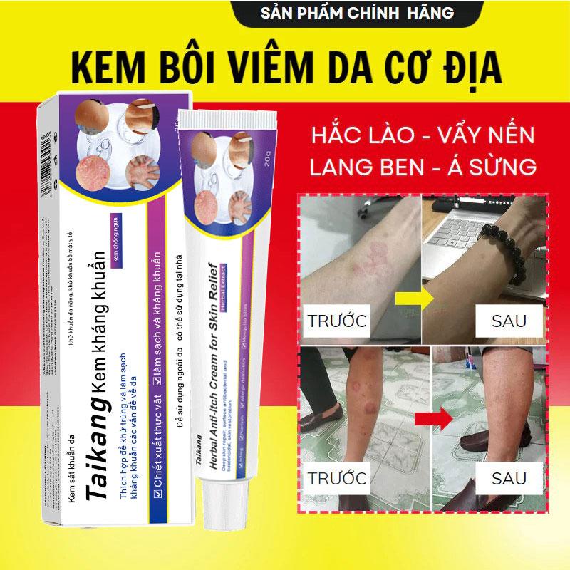 Taikang Kem Bôi Viêm Da Cơ Địa Chống Ngứa Ốc Sên Nấm Viêm Da Dị Ứng Tinea Corporis Capitis Nhiều Màu Hắc Lào Vẩy Nến Lang Ben Á Sừng