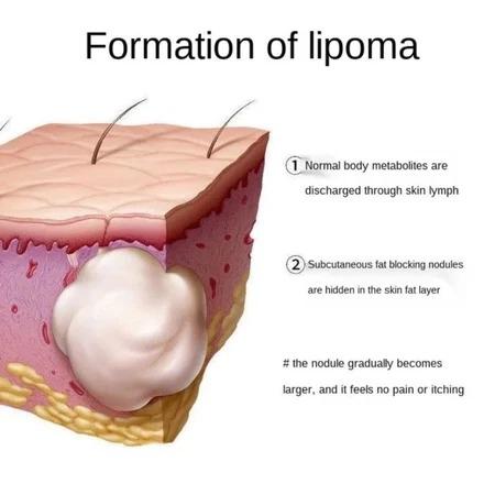 Lipoma Removal Cream Penghilang Kista & Lipoma Atasi Benjolan Lipoma Cepat Kempes Hilangkan Kista Lemak Kempes Tanpa Bedah