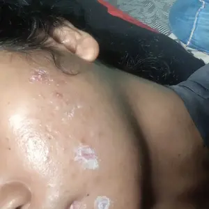 Viva Acne Lotion PM 30 ml