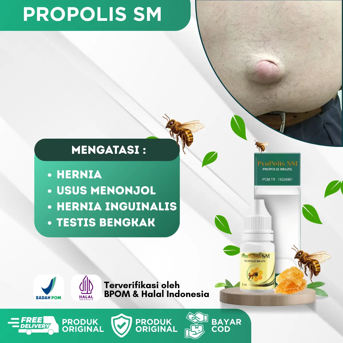 Propolis SM Hernia Turun Berok, Usus Menonjol Hernia Inguinalis, Testis Besar Sebelah, Hernia Anak, Hernia Dewasa