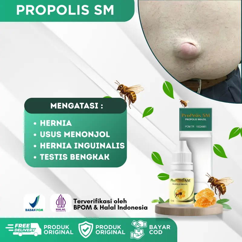 Propolis SM Hernia Turun Berok, Usus Menonjol Hernia Inguinalis, Testis Besar Sebelah, Hernia Anak, Hernia Dewasa 0