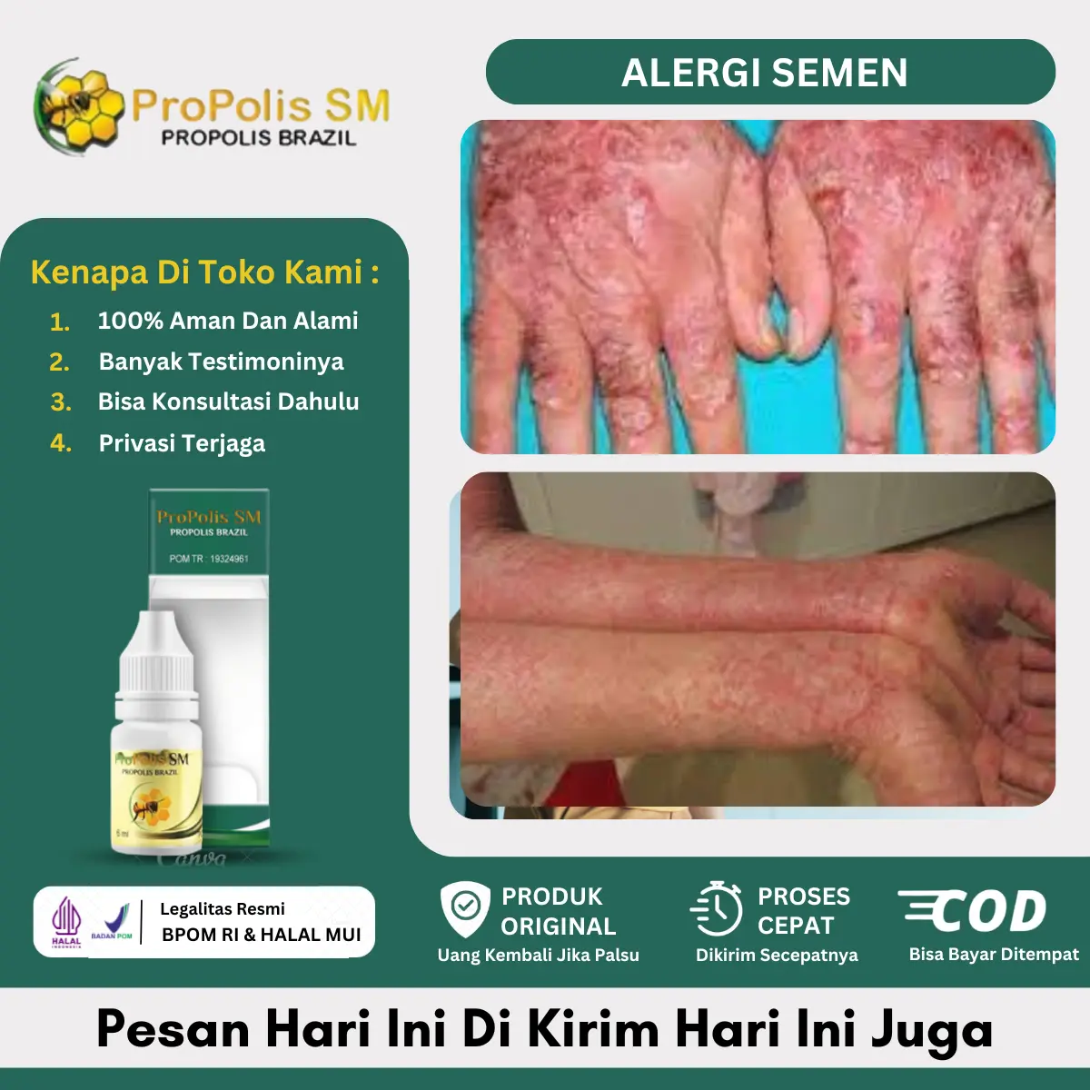 Propolis SM Alergi Semen, Dermatitis Kontak di Kaki dan Tangan, Penghilang Alergi Semen, Ruam di Kaki Kemerahan Gatal
