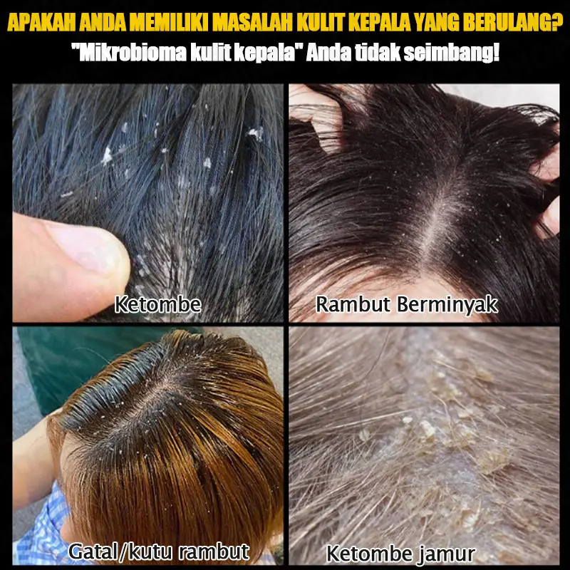 Shampoo Penghilang Ketombe Shampoo Psoriasis Anti Ketombe Dan Gatal Garam Laut Sampo Ketombe Shampoo Kutu Rambut Pengobatan Tungau Kulit Kepala Kering Dan Ketombe Mengontrol Minyak 3