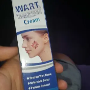 Krim kutil papiloma di leher, Cream penghilang kutil Wart Remover cream Krim Penghilang Lalat, Krim Penghilang Kutil