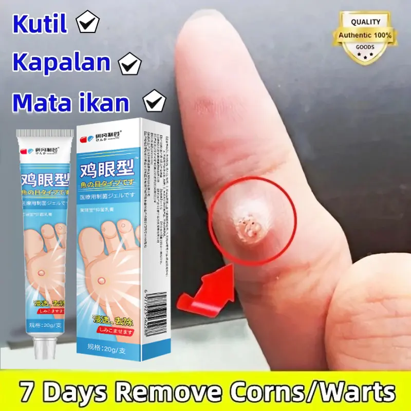 krim Mata Ikan Pada Telapak Kaki, Perontok Mata Ikan di Telapak Kaki & Tangan, Mata Ikan Di Kaki, Penghilang Mata Ikan, Kapalan di Kaki Tangan, Benjolan Keras di Telapak Kaki, krim Mata Ikan, Mata Ikan Tumbuh Lagi Dengan