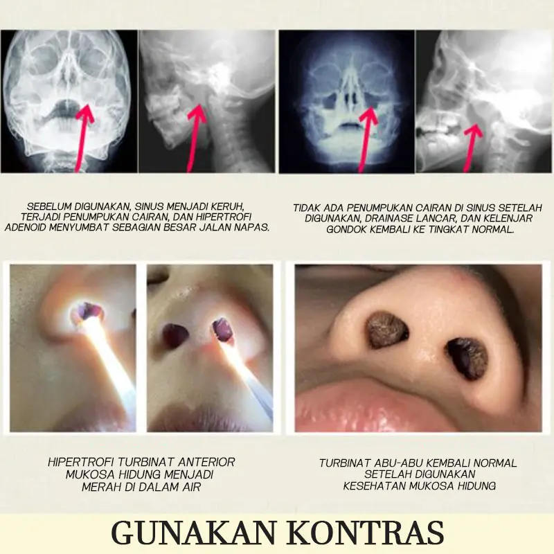 Obat Sinusitis Semprot Hidung Obat Polip Hidung Semprotan Hidung Nasal Spray Sinusitis Cuci Hidung Sinusitis Alat Hidung Tersumbat Obat Rhinitis Obat Hidung Gatal Cleaning 4