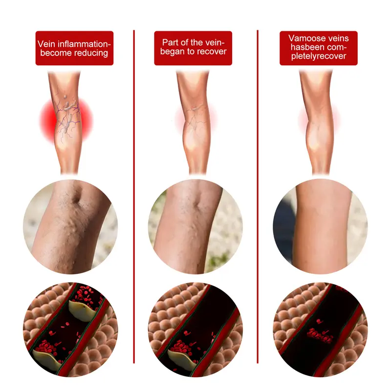 Intravenous massage spray for varicose veins relief and earthworm leg blood vessel bulge pain spray 3