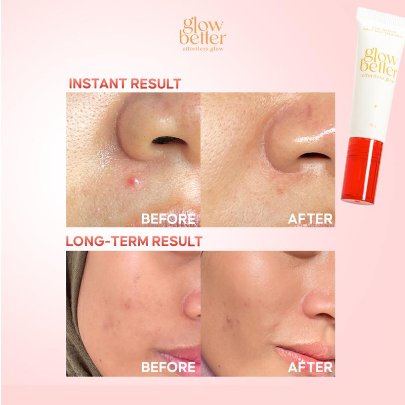 [FAHRY & NIZAR SPECIAL] Glow Better Acne Defense Daily Spot Treatment 10g Perawatan Gel Totol Jerawat Baik Untuk Kulit Berjerawat dan Kusam 3