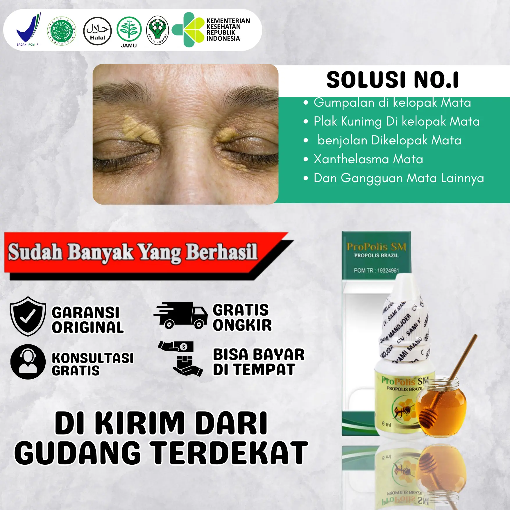 Propolis Sm Xanthelasma Penghilang Gumpalan Lemak di Kelopak Mata Salep Milia Bintik Di Dekat Mata Herbal