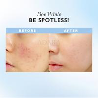 Gambar ADARA - Bee White Spotless Cream Obat Totol Bekas Jerawat Kemerahan dari Adara Cosmetics Kota Administrasi Jakarta Timur 4 Tokopedia