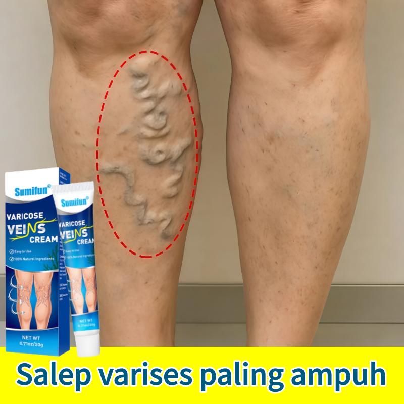 Obat varises Salep varises paling ampuh Varicose veins cream Krim Varises Di Kaki Dan Betis Menghilangkan Sakit Penghilang Varises - Beli 3 gratis 2