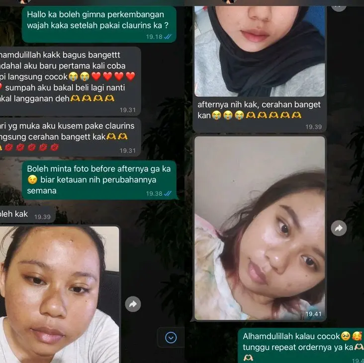 TERLARIS! ACNE TREATMENT SERIES Perawatan 6
