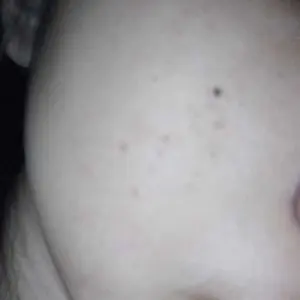 DOJAKO Acne Treatment Powder Water Perawatan Obat Totol Jerawat Hydrating Salicylic Acid Lactic Acid Calamine Centella Root Extract Berjerawat Kering Wajah Memudarkan