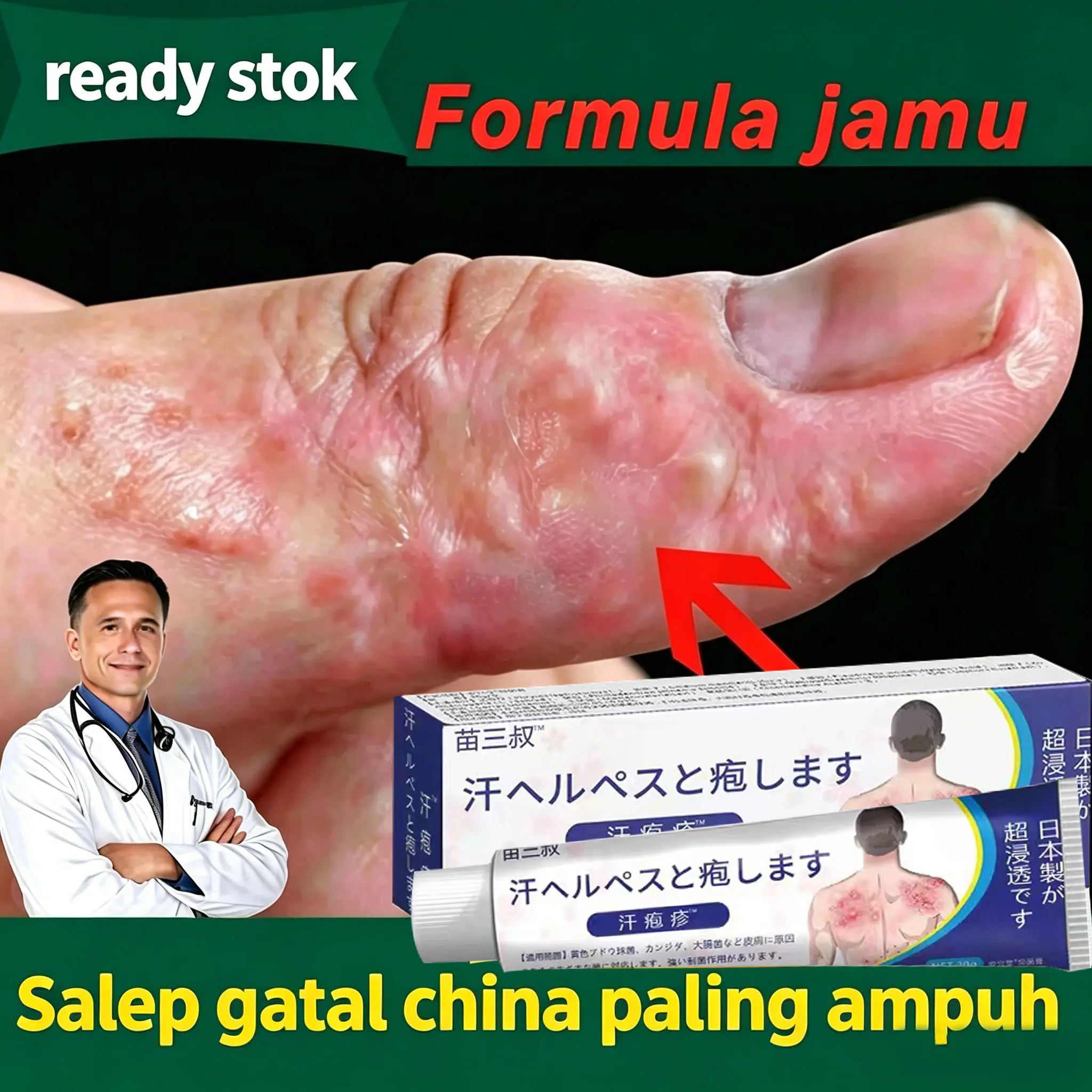 Original 100% - Sweat Herpes/Eczema Cream Anti Gatal / Salep Eksim Dermatitis / Krim Gatal Salep Gatal Psoriasis Salep Kulit Jamur Salep Eksim 20G Telapak Kaki