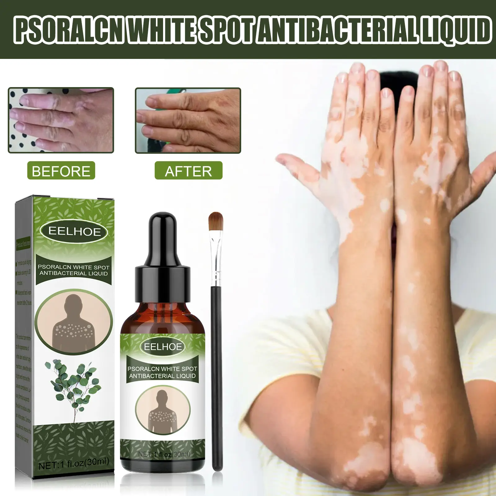 Vitiligo Clearing Essence Reduce Skin Dullness Cairan Antibakteri Mengurangi Vitiligo Salep Obat Vitiligo Panu Biang Keringat dengan Cepa Musuh Panu Membantu Pertumbuhan Melanin Krim Penyamar Noda