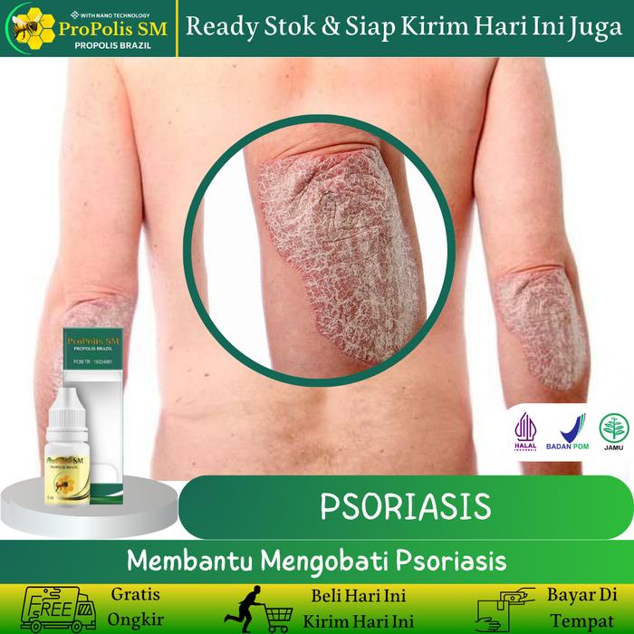 Gambar Propolis SM - Salep Psoriasis, Gatal Eksim, Jamur Eksim di tangan dan kepala Kering dari marsel herbal store Kota Administrasi Jakarta Barat Tokopedia