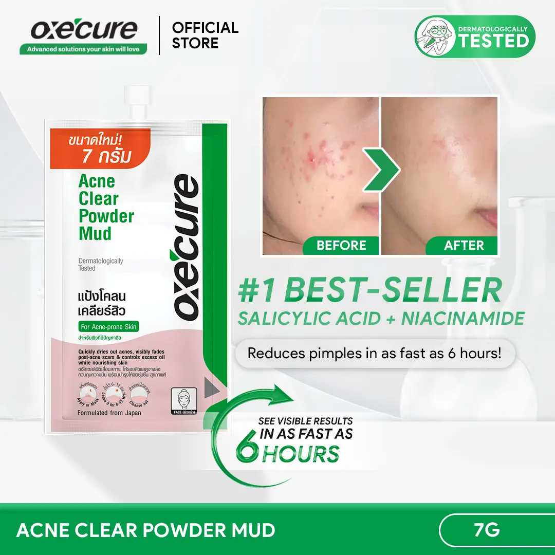 Stunning Acne Spot Treatment For Pimple Marks image