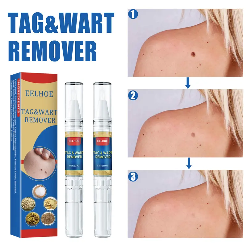 Wart Removal Pen Krim Penghilang Lalat, Krim Penghilang Kutil, Mudah Dibawa Untuk Semua Kulit, Krim Penghilang Kutil 3