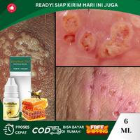 Gambar Luka Kemaluan, Salep Luka Lecet Di Kemaluan, Balanitis, Herpes Genital, Iritasi Kulit Kelamin Pria/Wanita Dengan ProPolis SM Cairan Tetes dari Dyna Herbs Kota Administrasi Jakarta Barat 1 Tokopedia