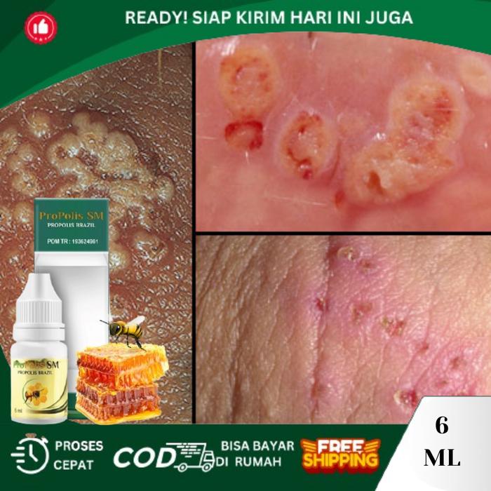 Gambar Luka Kemaluan, Salep Luka Lecet Di Kemaluan, Balanitis, Herpes Genital, Iritasi Kulit Kelamin Pria/Wanita Dengan ProPolis SM Cairan Tetes dari Dyna Herbs Kota Administrasi Jakarta Barat Tokopedia