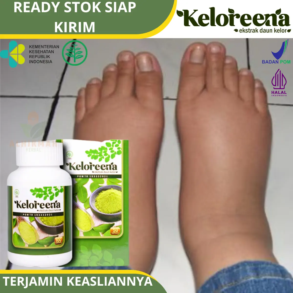Keloreena - Untuk Kaki Bengkak Karena Rematik, Asam Urat, Diabetes, Edema Penumpukan Cairan Di Kaki