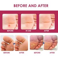 Gambar Plester Mata Ikan Paling Ampuh Obat Mata Ikan Kaki Penghilang Mata Ikan Di Tangan Foot Corn Removal Plester Stiker - 1PCS dari Polkadope Indonesia Kota Tangerang 5 Tokopedia