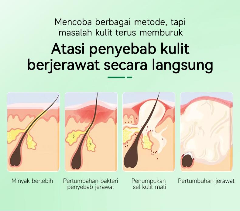 Product Introduction of （T1）BPOM.Beli 2 Gratis 1.Challenge 7 Hari Jerawat Hilang,CINSULIN Obat Jerawat Herbal Ekstrak Alami Cepat Hilangkan Komedo & Jerawat Meradang  BPOM Certified  Aman untuk Remaja & Kulit Sensitif Berjerawat Wajah Gatal Beruntusan 2