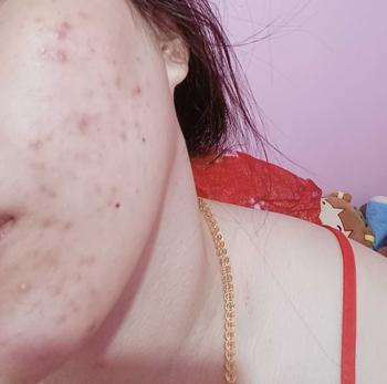 Product Review of [Mã 3] Mua 1 Tặng 1, ACNE SERUM - Serum Diếp Cá 5ml Hỗ Trợ Cải Thiện Mụn - Thương Hiệu: LE'PEAU from ** N**c Y** ** 1