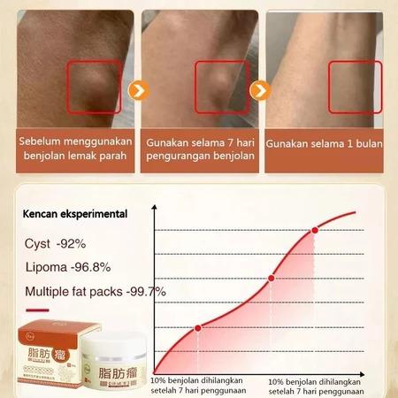 Lipoma Removal Cream Penghilang Kista & Lipoma Atasi Benjolan Lipoma Cepat Kempes Hilangkan Kista Lemak Kempes Tanpa Bedah