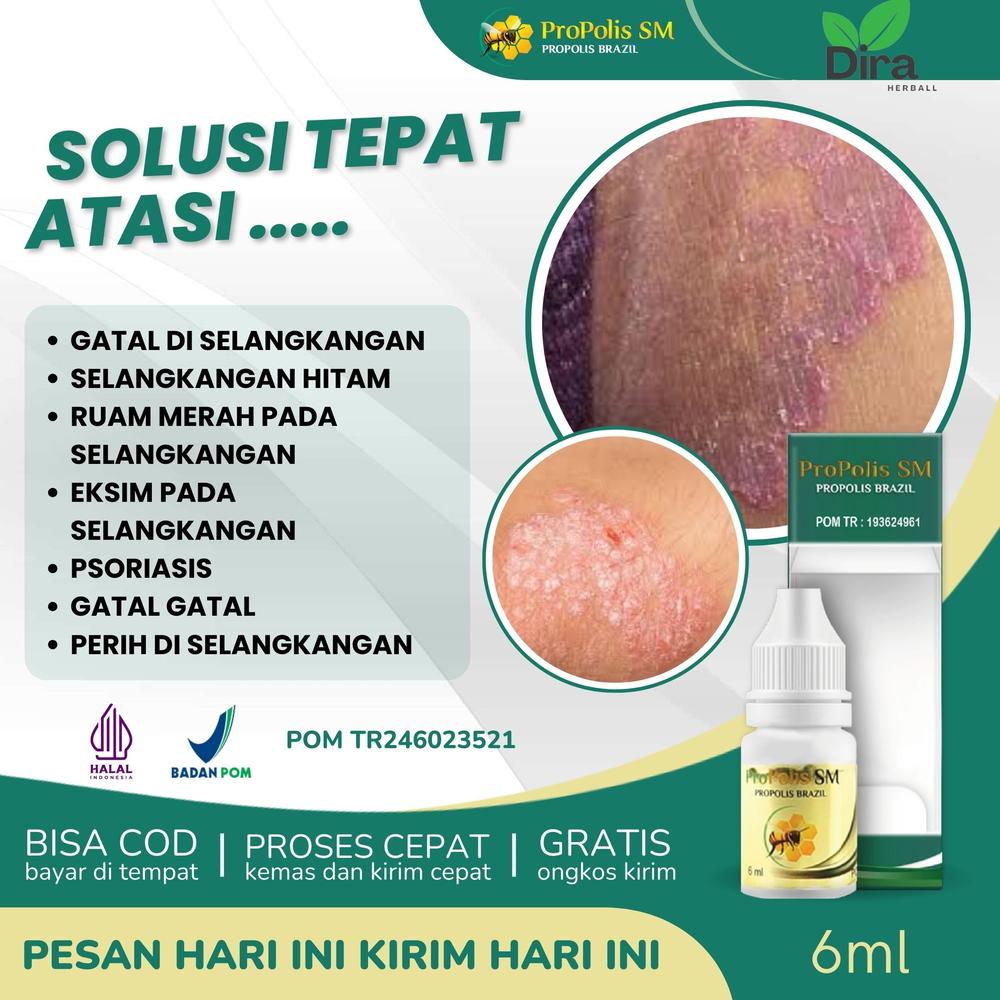 Propolis SM Herbal Untuk Gatal Selangkangan Bisa Buat Wanita & Pria, Kulit Eksim Kering, Perih, infeksi Jamur, Menghitam, Gatal2 Kemaluan, Benjolan Miss V Lecet, Bengkak dan Sakit, Bokong Gatel, Miss 
