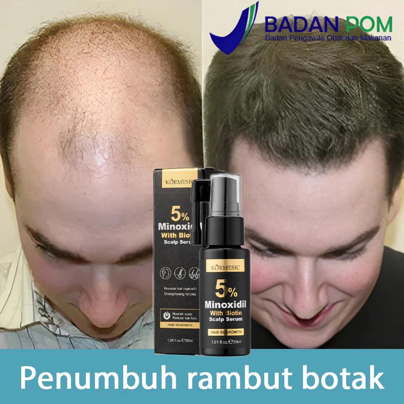 Minoxidil Penumbuh Rambut Serum Obat Penumbuh Rambut Botak Tipis Dan ...
