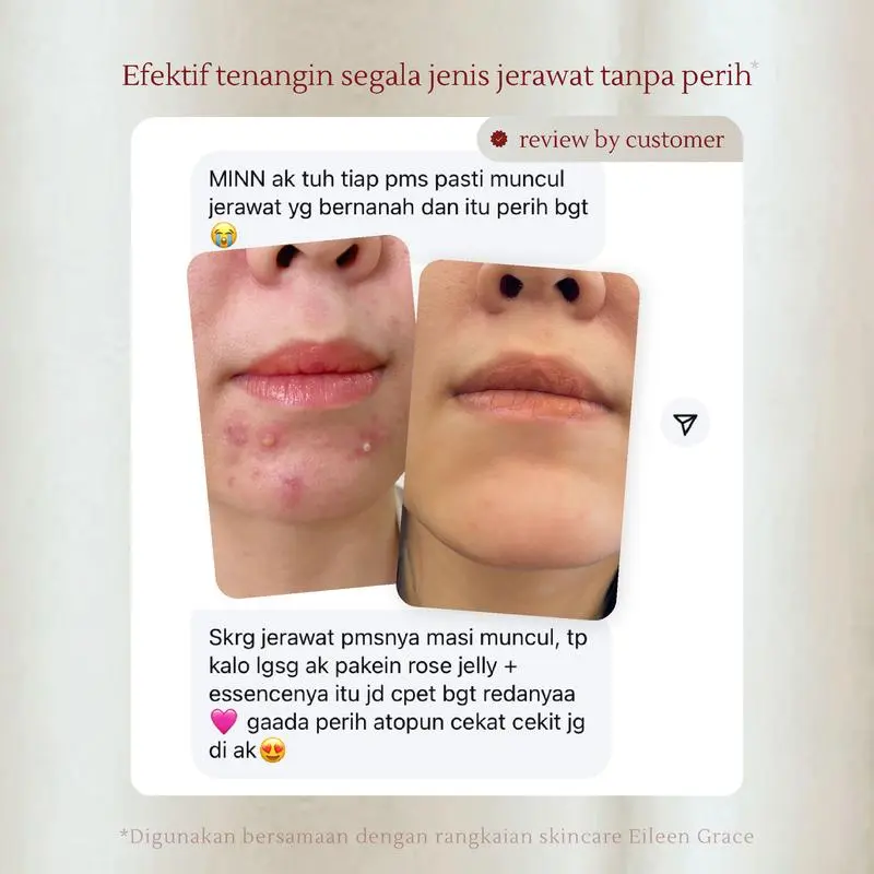 [SPECIAL LIVE] EILEEN GRACE - Moisturize Rose Jelly Mask 300 ml | Masker / skincare jerawat I Kulit kering sensitif | Bekas jerawat | Kemerahan | Bruntusan | Bopeng 2