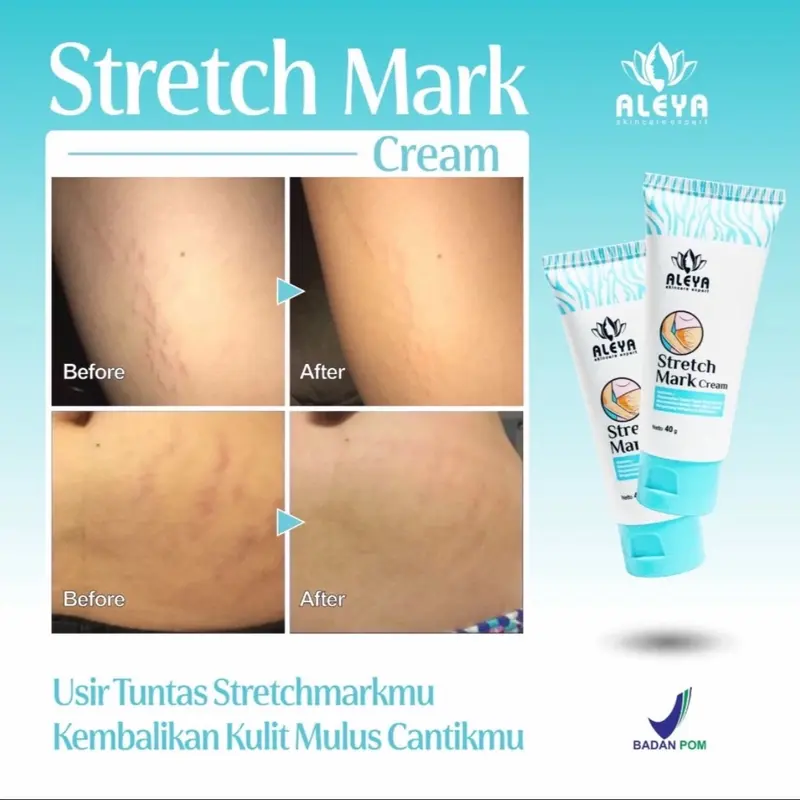 ALEYA STRETCHMARK CREAM KRIM STRETCH MARK CREAM PENGHILANG BEKAS LUKA STRETCH MARK BY ALEYA SKINCARE EXPERT 3