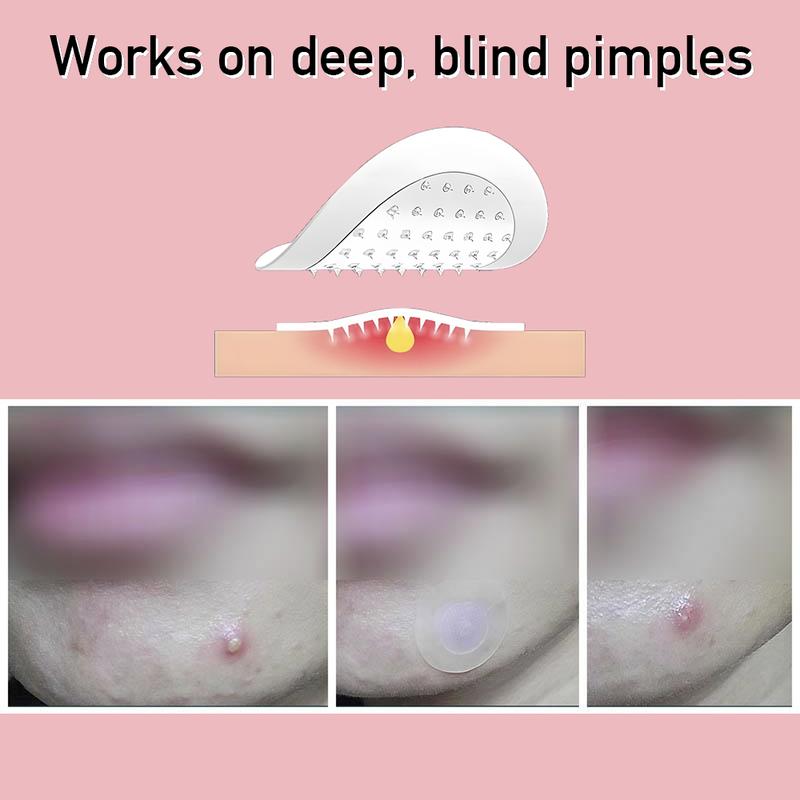 [New Upgrade]ROWMSHI Microdarts for Acne Microneedle Patches for Blind Pimples Microdart Acne Patches Pure Hydrocolloid Skincare Skin Repair Pimole Needle Patch Microneedle 6