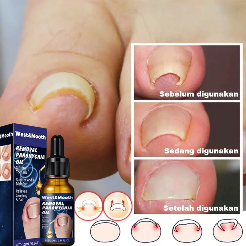 Obat cantengan jempol kaki kuku obt kuku jamur dan rusak original Meredakan Nyeri dan Pembengkakan dengan Cepat