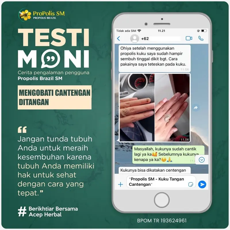 Propolis SM untuk Kuku Cantengan Jempol Kaki Bengkak Nyeri Bernanah Bau 2
