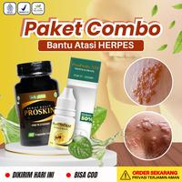 Gambar [PAKET COMBO] - Perawatan Kulit Untuk Herpes Zoster Herpes Genital / Kelamin Herpes Bibir Aman Untuk Anak Dan Dewasa - Cairan Oles Penghilang Herpes - PAKET COMBO (PSM + SKIN) dari Tria Herbal Store Kota Administrasi Jakarta Barat 1 Tokopedia