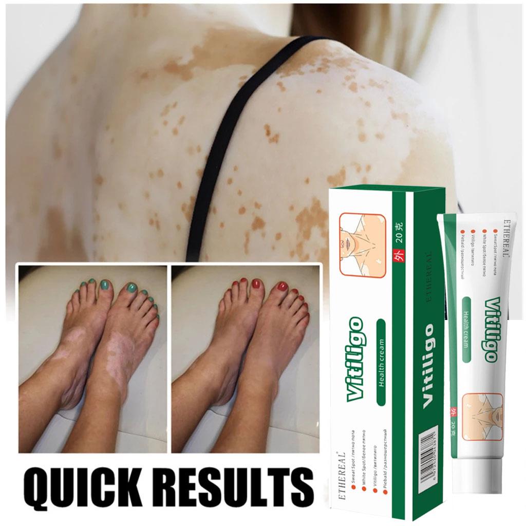 Obat Penghilang Vitiligo Salep Krim Vitiligo Bintik Putih Salep vitiligo Obat vitiligo untuk kulit bercak putih jerawat keringat  krim concealer noda melanin salep khusus vitiligo
