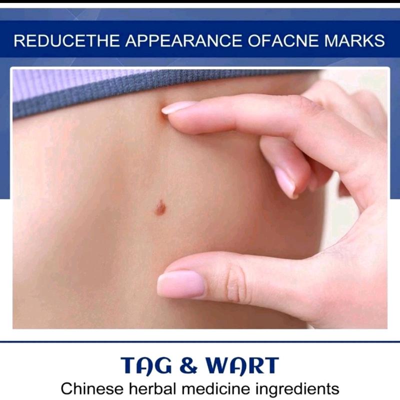 Penghilang Kutil Wart Remover Skin Tag Remover Penghilang Tahi lalat Salep Penghilang Flek Hitam Perawatan 2