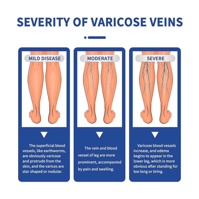 Product Introduction of South Moon Pijat Vena Varises Krim Perbaikan Kaki Cacing Tanah Meringankan Vena Varises yang Menonjol di Kaki Extract Ceramide 8