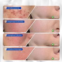Gambar Krim Penghilang Bekas Luka & Jerawat-30g Penghilang bekas jerawat Krim wajah-Obat jerawat pemulihan bekas-Mencegah Luka Jadi Keloid & Menyamarkan Bekas Hitam - 30ML dari Sumifun Beauty Indonesia Kab. Bekasi 5 Tokopedia