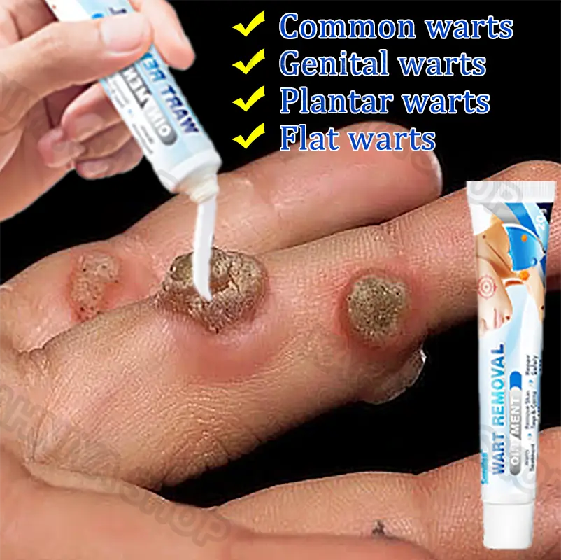 Salep Obat Kutil Paling Wart Removal Cream Penghilang Tahi Lalat Krim Penghilang Lalat Krim Penghilang Kutil Wart Remover Ointment Skin Tag Remover Menghilangkan Kutil Tahi Lalat Mata Ikan