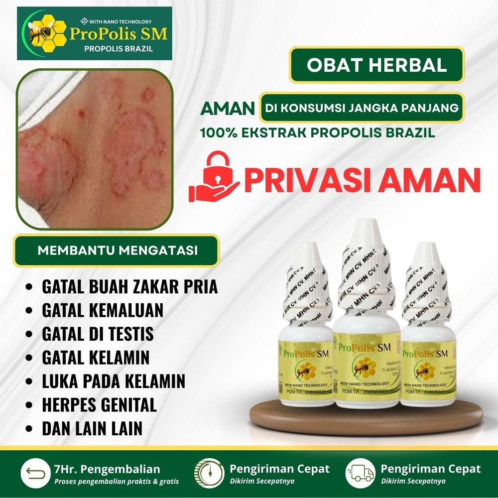 Gatal Buah Zakar Pria, Gatal Di Buah Zakar Pria, Luka Pada Kelamin Pria Kulit Batang Kemaluan Lecet Mr P Perih Gatal Di Buah Zakar Iritasi Kelamin Bentol Herpes Genital Dengan Propolis SM
